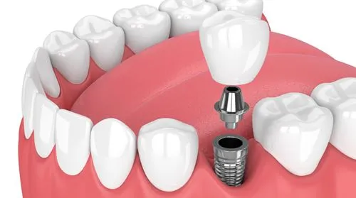 Diş İmplantları Biyoteknolojinin Neresinde?